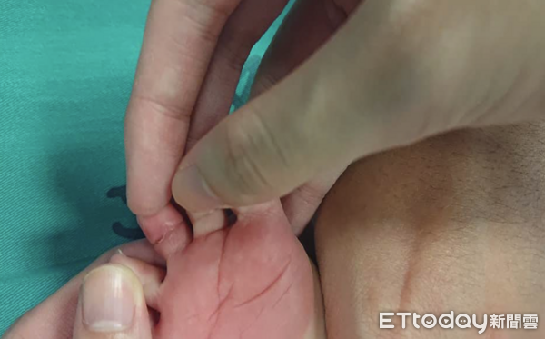 ▲▼    止血帶症候群         。（圖／許丁元醫師提供）