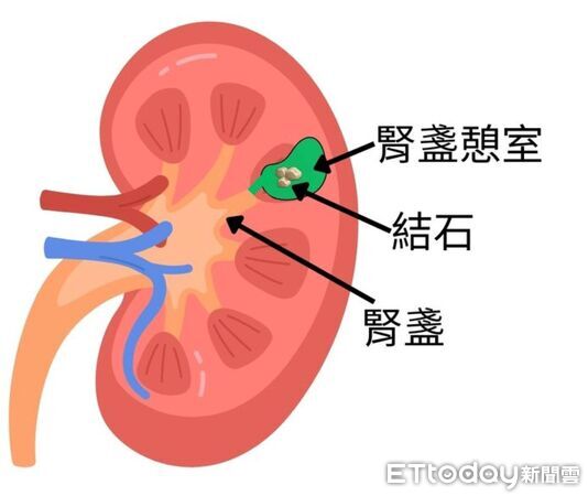 ▲▼     罕見結石        。（圖／台北慈院提供）