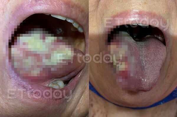 ▲▼門診飄出腫瘤味！她一開嘴「右邊全都是」醫心涼　拖半年慘變三期。（圖／呂弘鈞醫師授權提供，未經同意請勿任意翻攝）