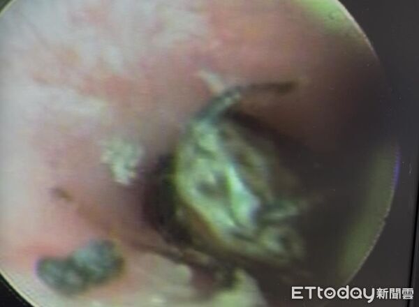 ▲國中妹耳暴痛！醫夾出「活體小強猛踢腿」　13秒尖叫片曝光。（圖／莊宇龍醫師授權提供，未經同意請勿任意翻攝）