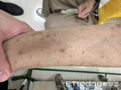 癢爆1年沒睡好！她全身冒「結痂疹子」　醫：變性纖維往外排