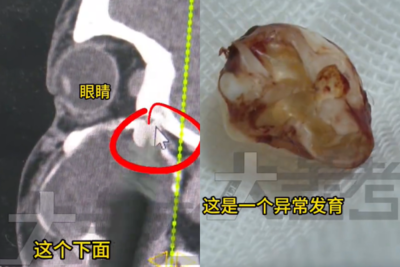 15歲陸男嘴歪竟是「智齒長到眼窩裡」　母親傻：起初以為吃胖了