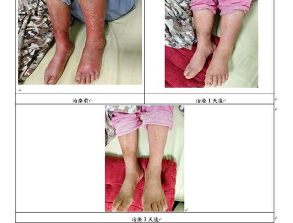 ▲下肢紅腫未必是蜂窩性組織炎