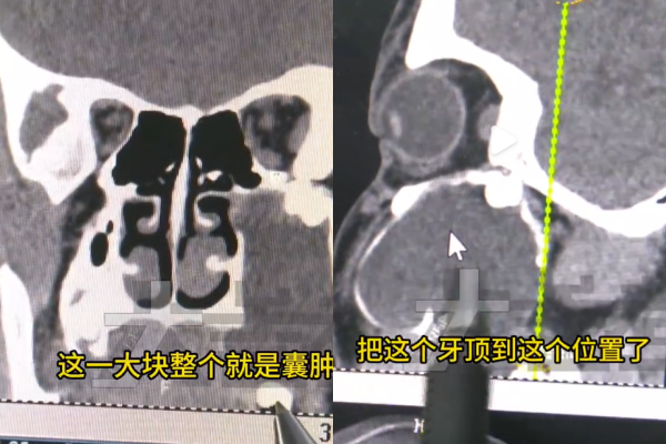 ▲▼15岁陆男嘴歪竟是智齿长到眼窝里。 (图/翻摄自微博)