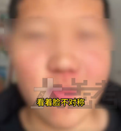 ▲患者母亲起初以为是儿子吃胖了。 (图/翻摄自微博)