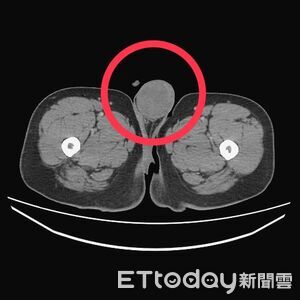 獨／台中七期百貨男咳血　竟是睪丸癌末全身轉移！確診1個月亡
