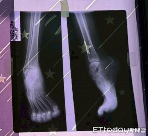 ▲▼  aiwan Can Help醫療跨越海洋　嘉基赴菲義診助少女重拾行走希望  。（圖／嘉義基督教醫院提供）