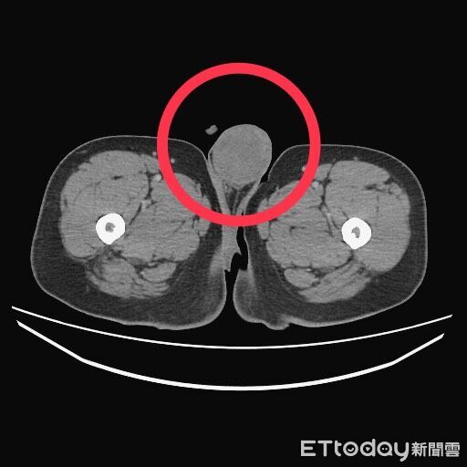獨/台中七期百貨男咳血 竟是睪丸癌末全身轉移!確診1個月亡