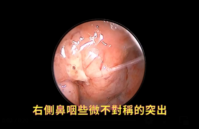 ▲▼鼻咽癌。（圖／童寶奎醫師授權提供）
