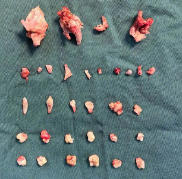 ▲▼18歲女腹中長「24顆牙齒腫瘤」。（圖／翻攝自微博）
