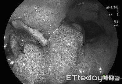 老婆嫌嘴太臭！科技男「頻冒2症狀」求救　醫一照嘆：是胃癌