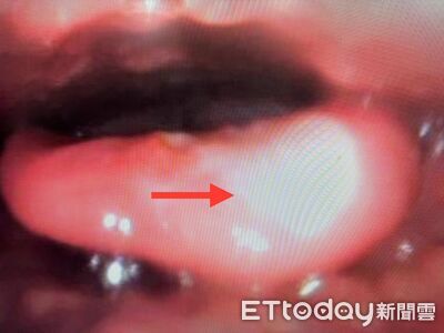 高中生「喉嚨痛爆1週」！醫驚見致命危機：有人插管才撿回一命