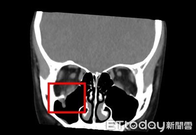 9歲童碰撞「眼球忽然轉不動」　醫揭「線性爆裂性骨折」4警訊