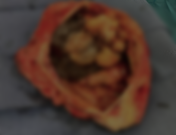 ▲曾琳琳體內的腫瘤。（圖／翻攝自微博）