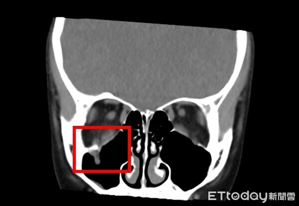 ▲▼     眼窩骨折        。（圖／中山附醫提供）