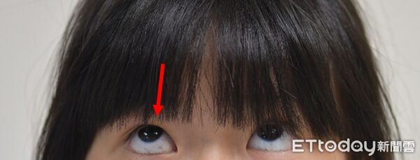 ▲▼     眼窩骨折        。（圖／中山附醫提供）