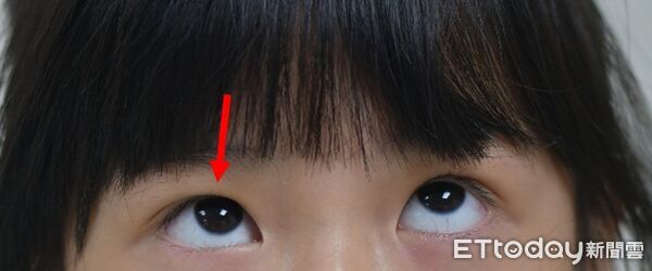 ▲▼     眼窩骨折        。（圖／中山附醫提供）