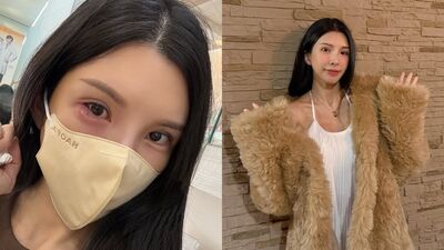 「國光女神」長針眼痛到崩潰大哭　眼睛劇紅近照曝光