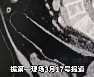 假陽具「滑入肛門」腸穿孔！他忍3天就醫：不小心坐到