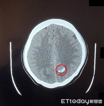 ▲▼23歲女頭痛到吐竟腦出血！醫驚見「像氣球破裂」　4徵兆別拖了。(圖／大千綜合醫院提供)