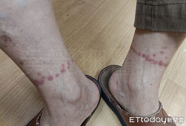▲雙腳冒紅疹「像被畫一圈」！醫見恐怖排列驚：牠邊走邊咬。(圖/黃麗珊醫師授權提供，未經同意請勿翻攝)