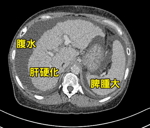 ▲▼米德莉腹部電腦斷層掃描顯示肝臟已出現嚴重的「肝硬化」現象，並伴隨明顯的「腹水」蓄積以及「脾腫大」。（圖／馬偕醫院提供）