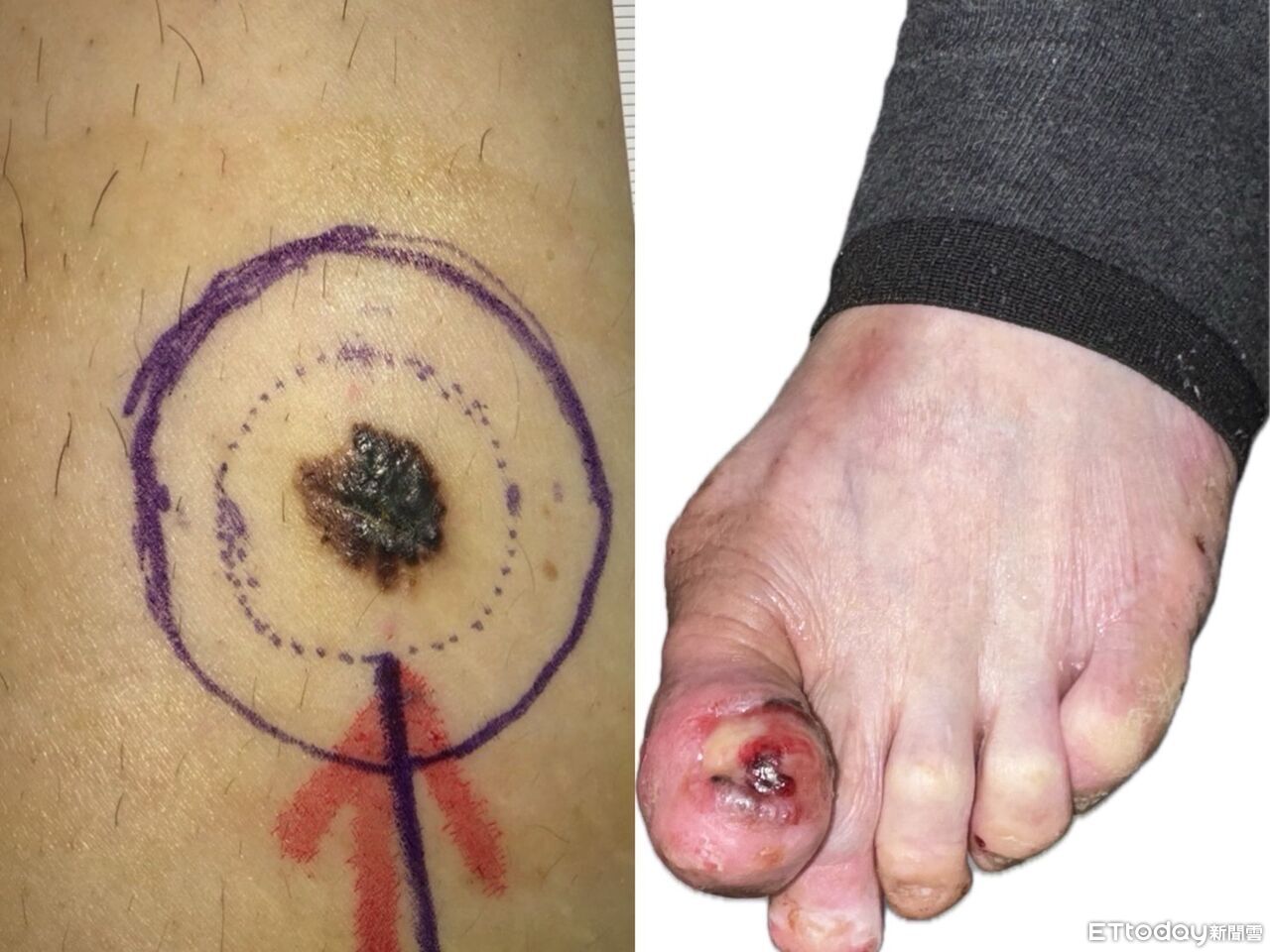 不是甲溝炎!腳趾頻化膿長肉芽...竟是「皮膚癌王」 截肢保命