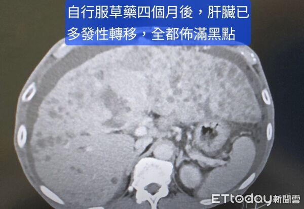 ▲▼「我會開草藥！」大哥肝癌破裂拒醫　4個月後虛弱求救：這癌很惡。（圖／林群峰醫師授權提供，未經同意請勿任意翻攝）