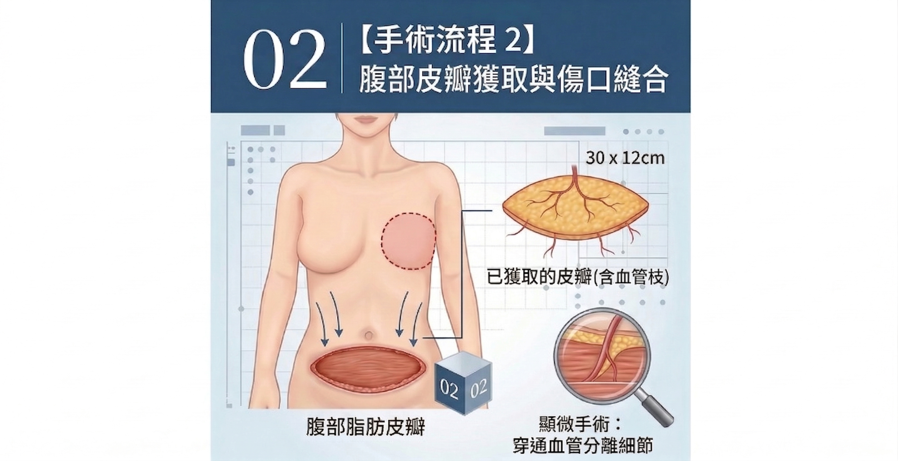 ▲▼乳癌,乳房切除,乳房重建,深下腹動脈穿通枝皮瓣,自體組織,移植。（AI協作圖／記者胡至欣製作，經編輯審核）