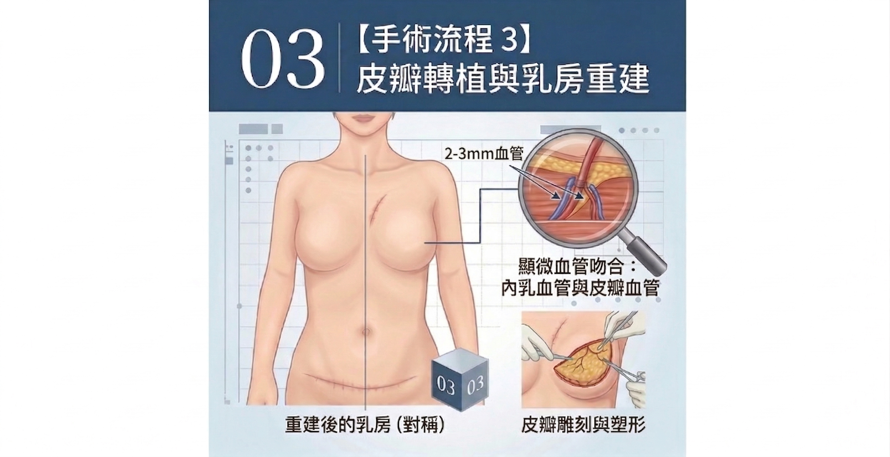 ▲▼乳癌,乳房切除,乳房重建,深下腹動脈穿通枝皮瓣,自體組織,移植。（AI協作圖／記者胡至欣製作，經編輯審核）