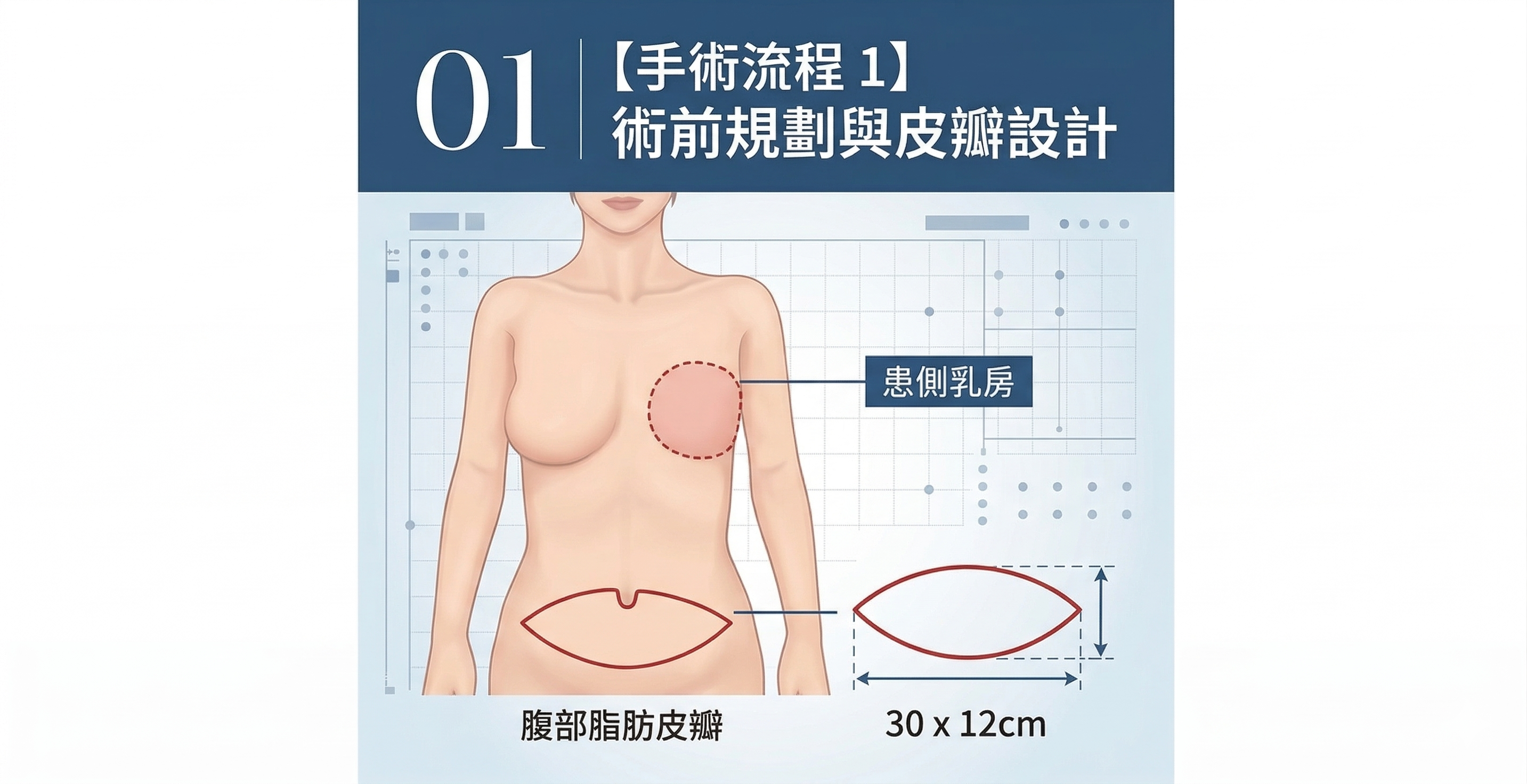 ▲▼乳癌,乳房切除,乳房重建,深下腹動脈穿通枝皮瓣,自體組織,移植。（AI協作圖／記者胡至欣製作，經編輯審核）
