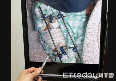 日本滑雪摔斷腿竟藏「6cm腫瘤」　30歲男返台求醫「真相」曝光