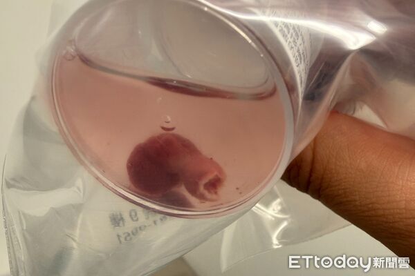 ▲▼以為痔瘡！20歲弟大便有血　醫夾出「粉色帶莖肉塊」驚：這養很久。（圖／吳宗勤醫師授權提供，未經同意請勿任意翻攝）