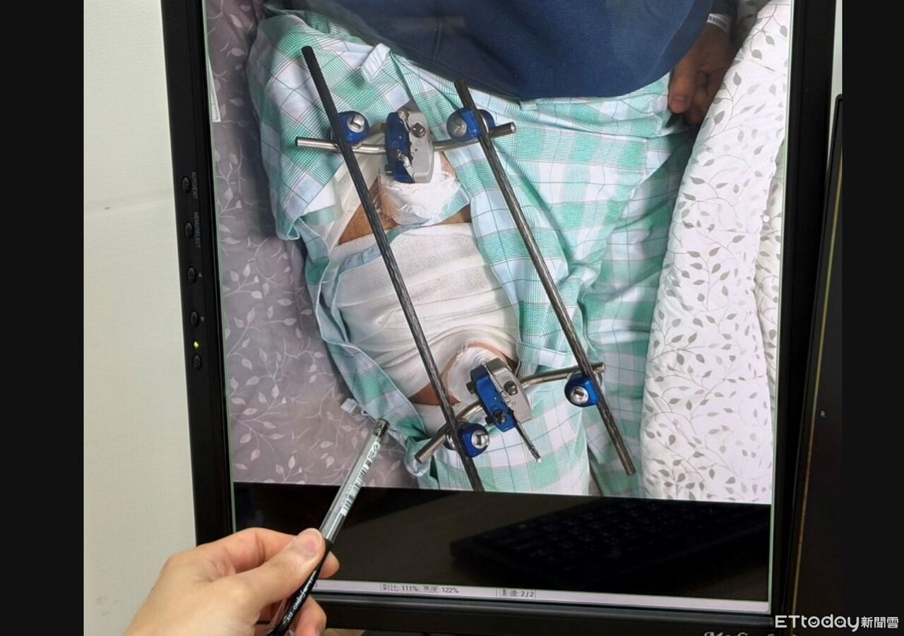 日本滑雪摔斷腿竟藏「6cm腫瘤」 30歲男返台求醫「真相」曝光