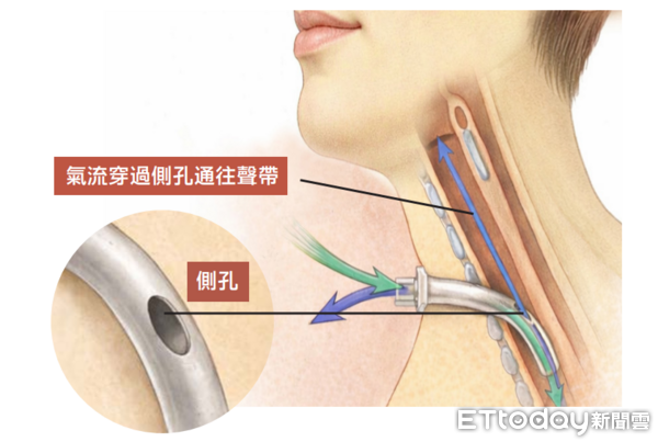 ▲▼    氣切         。（圖／雙和醫院提供）