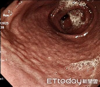 15歲弟突吐血！胃鏡驚見「滿滿鵝卵石」　醫：80%胃癌和它有關