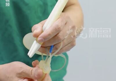 陸73歲翁植19公分假體解決勃起障礙　為了小30歲妻欲重振雄風