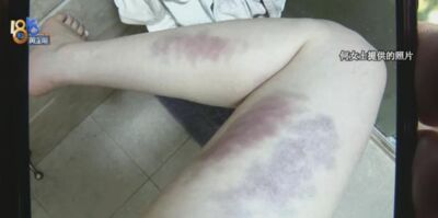 陸女子做瑜伽「教練幫舒緩肌肉」　拿「狼牙棒」按摩腿瘀青一年未消