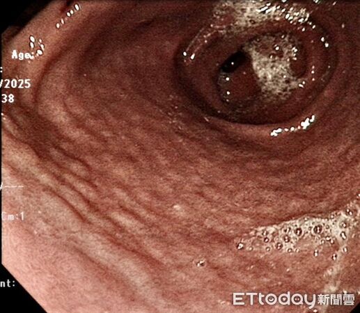 ▲▼15歲弟突吐血「胃長滿鵝卵石」！醫切片驚：80%胃癌和它有關。（圖／洪華希醫師授權提供，未經同意請勿任意翻攝）