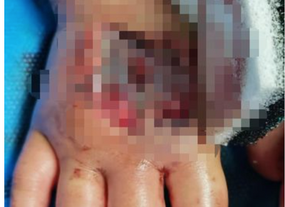 雲南3歲女童遭眼鏡王蛇咬「假死」3天　72小時內跨省急救奇蹟生還