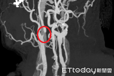中年男突頭暈、黑矇...就醫發現頸動脈狹窄　醫師提醒中風風險高