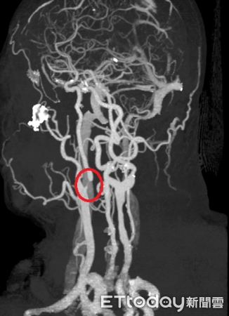 ▲頭暈、黑矇別輕忽！醫：恐是頸動脈狹窄警訊，中風風險高。（圖／衛福部南投醫院提供）