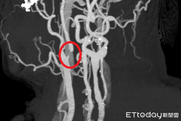 ▲頸動脈狹窄影像圖。（圖／衛福部南投醫院提供，下同）
