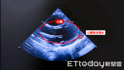 1歲童高燒腹瀉被誤當腸胃炎　醫：川崎氏症未及早確診恐傷心臟