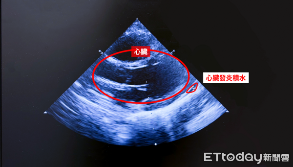 ▲▼     川崎氏症        。（圖／中醫大新竹附醫提供）