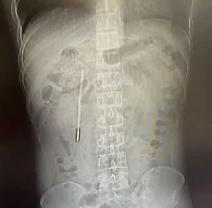 陸男12歲吞體溫計　32歲「消化不順」才想起