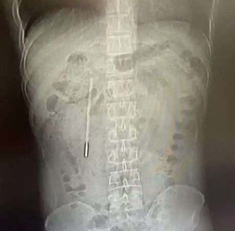 ▲▼陸男12歲吞體溫計　32歲「消化不順」才想起。（圖／翻攝微博）