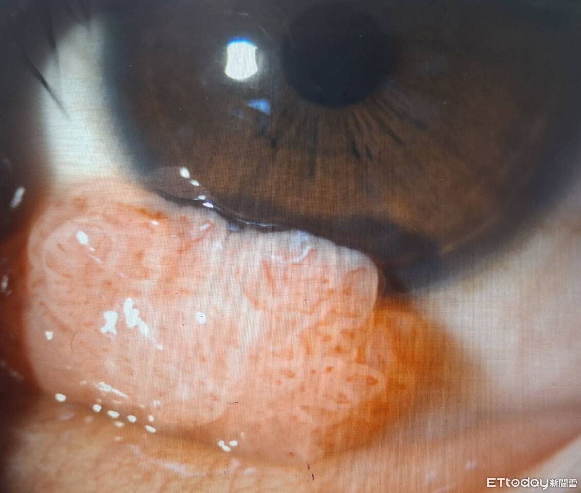 針眼3個月不退超瞎原因曝 男臉貼私密處吞吐「眼睛染菜花」
