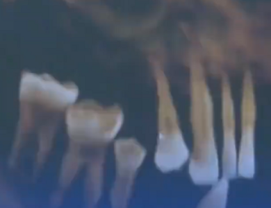 44歲陸男已拔14顆牙　醫一聽生活習慣嘆：剩下的牙也要拔光