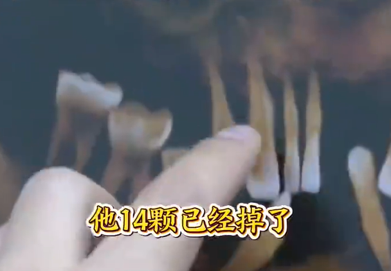 ▲▼44歲陸男已拔14顆牙。（圖／翻攝自微博）